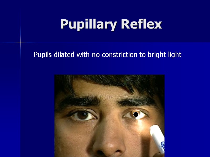 Pupillary Reflex Pupils dilated with no constriction to bright light